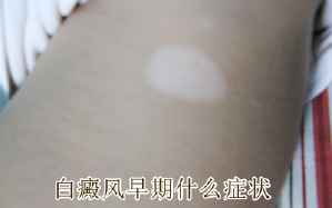 白癜风病因
